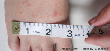 Chigger Bites on a Human Foot