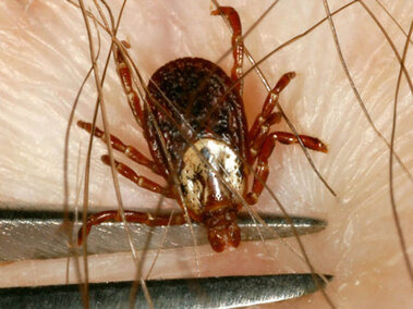 magnified view of a tick on human skin being removed with tweezers